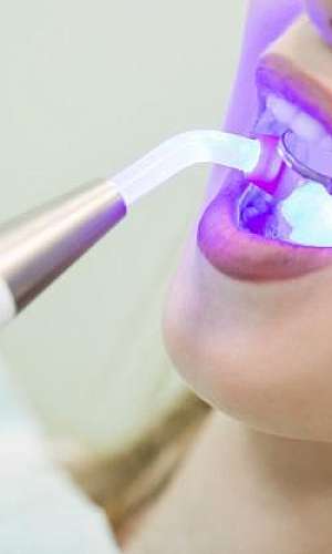 Fabricante de lâmpada UV dentista Fabricante de lâmpada UV dentista